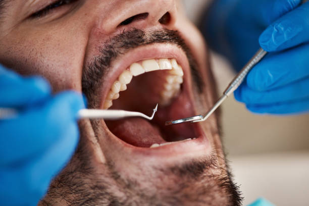 Best Root Canal Treatment  in Nevada, IA